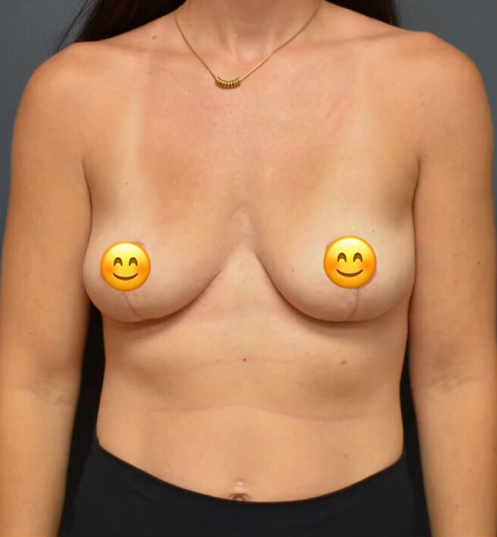 Breast Lift Case 24085 After Photo Breast Lift