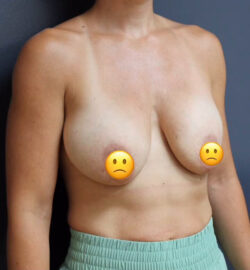 Breast Lift