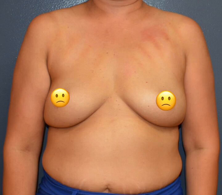 Breast Augmentation