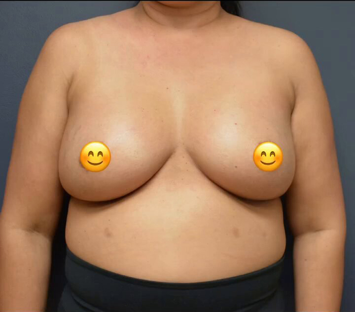 Breast Augmentation