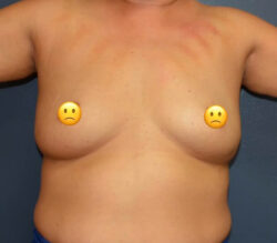 Breast Augmentation
