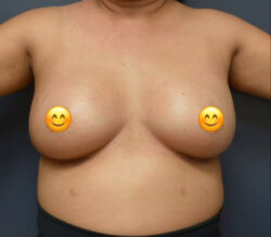 Breast Augmentation