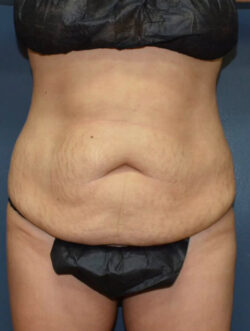Abdominoplasty