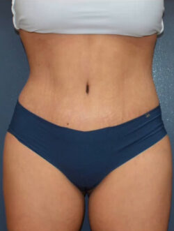 Abdominoplasty