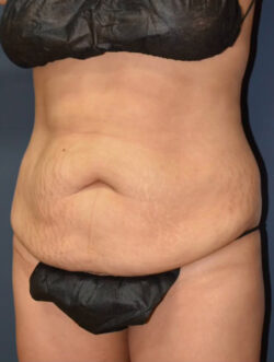 Abdominoplasty