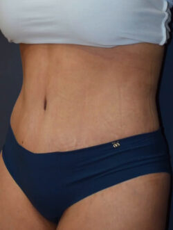 Abdominoplasty
