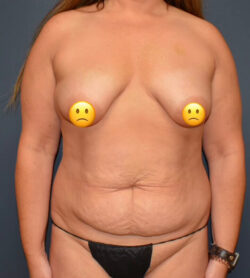 Mommy Makeover