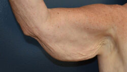 Arm Lift