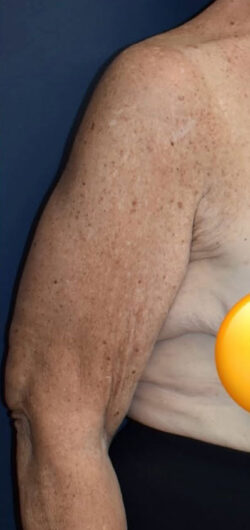 Arm Lift