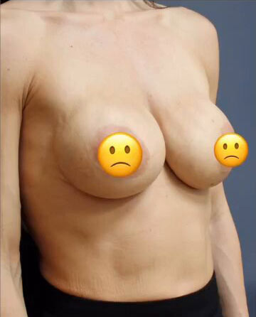 Breast Revision