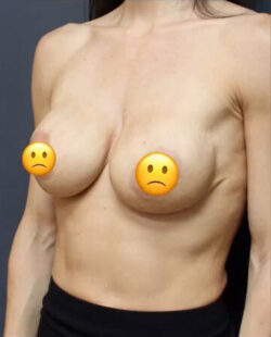 Breast Revision