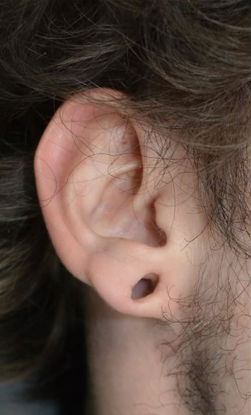 Earlobe Repair Case 25078 Before Photo Earlobe Repair