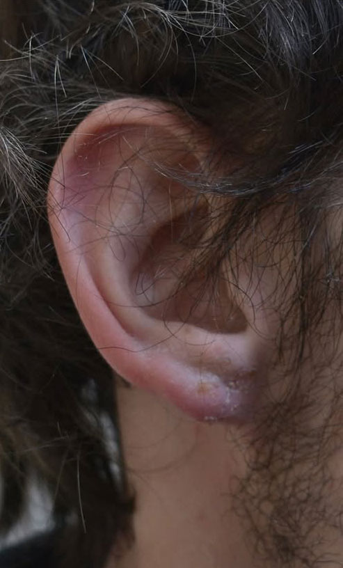Earlobe Repair Case 25078 After Photo Earlobe Repair