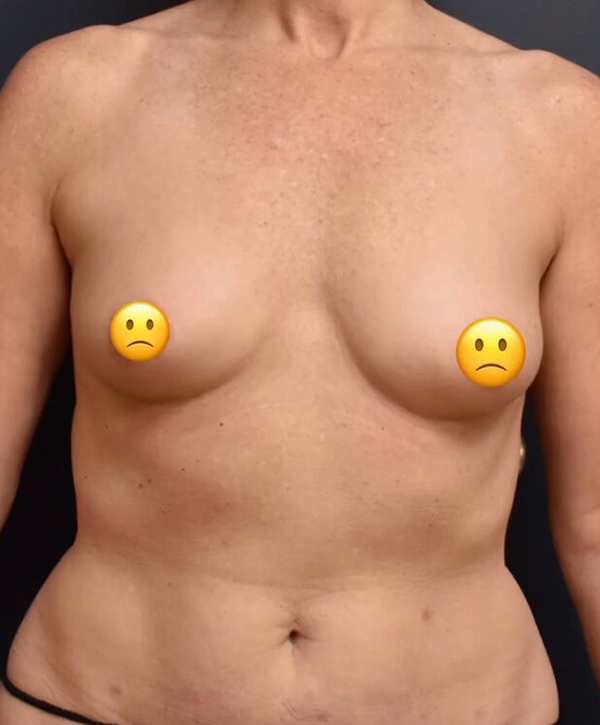 Breast Augmentation Case 25079 Before Photo Breast Augmentation