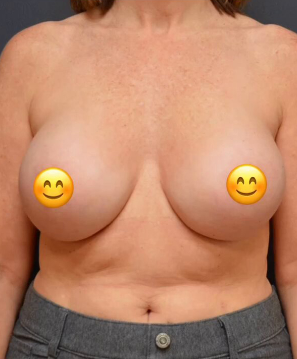 Breast Augmentation Case 25079 After Photo Breast Augmentation