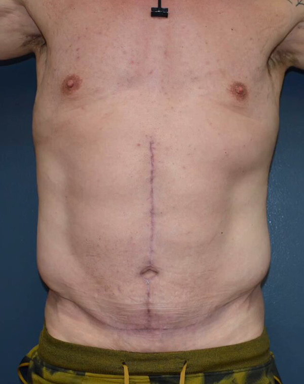 Abdominoplasty Case 25492 After Photo Abdominoplasty