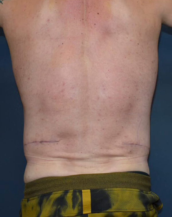 Abdominoplasty