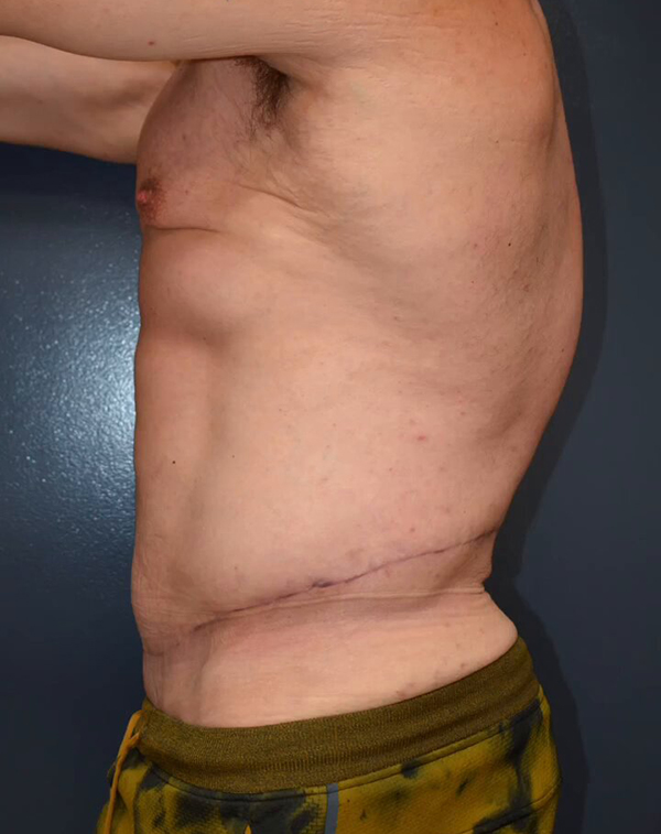 Abdominoplasty