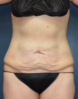 Abdominoplasty
