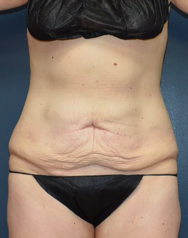 Abdominoplasty Case 25494 Before Photo Abdominoplasty