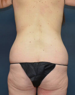 Abdominoplasty