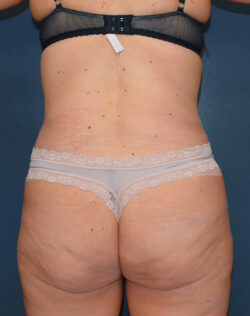 Abdominoplasty