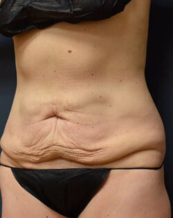 Abdominoplasty