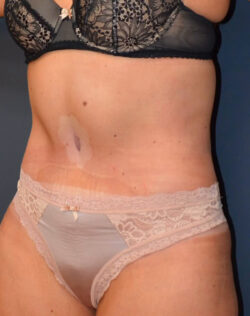 Abdominoplasty
