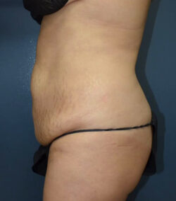 Abdominoplasty