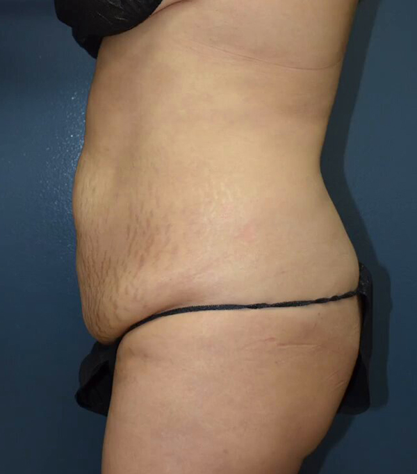 Abdominoplasty