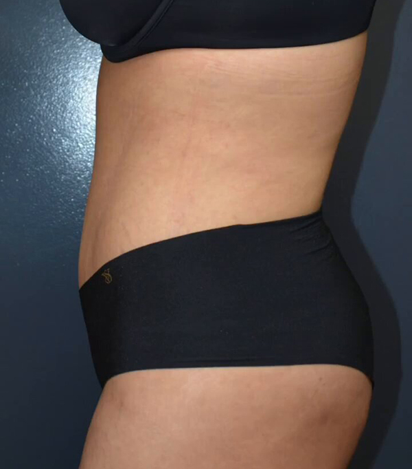 Abdominoplasty
