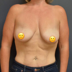 Breast Lift with Augmentation