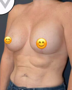Breast Lift with Augmentation