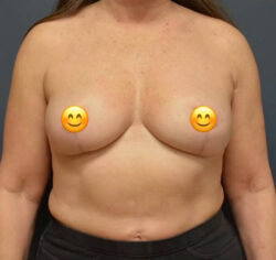 Breast Reduction