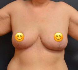 Breast Reduction