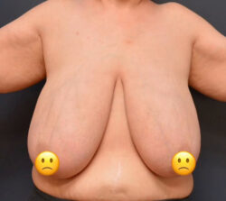Breast Reduction