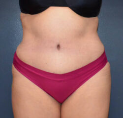 Abdominoplasty