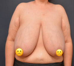 Breast Reduction
