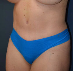 Abdominoplasty