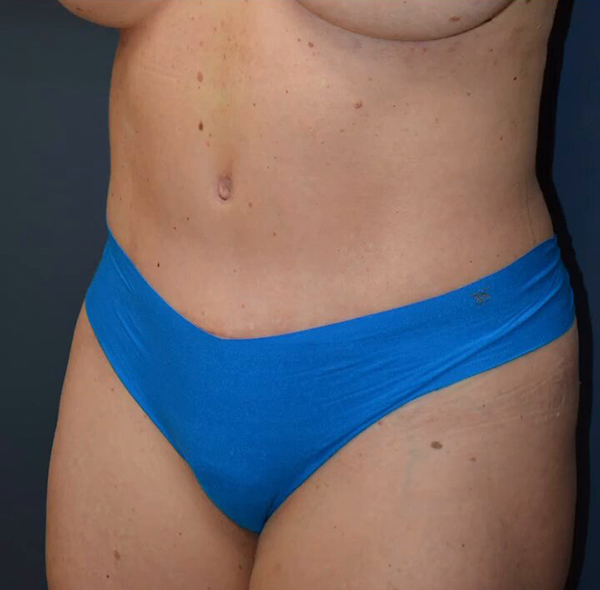 Abdominoplasty