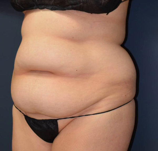 Abdominoplasty