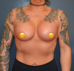 Breast Augmentation