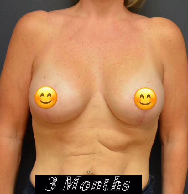 Breast Lift with Augmentation