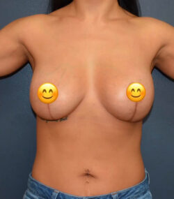 Breast Revision