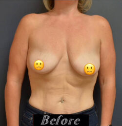 Breast Lift with Augmentation