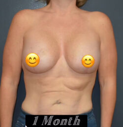 Breast Lift with Augmentation