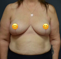 Breast Reduction