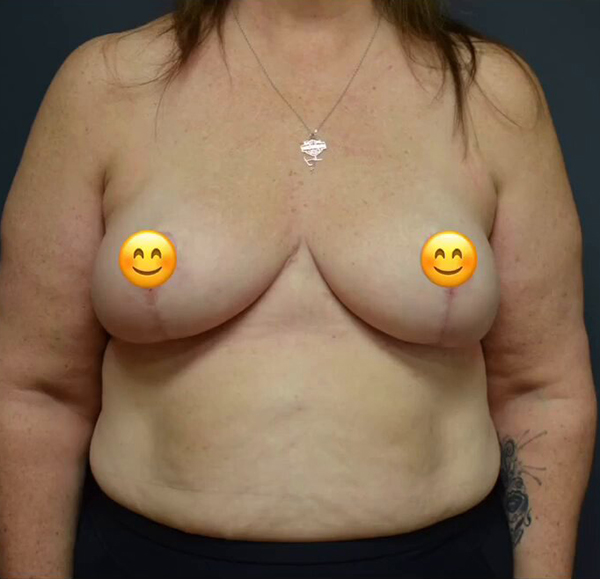 Breast Reduction