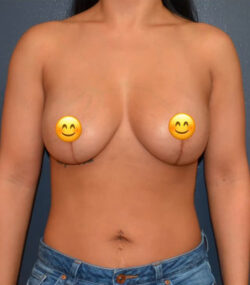 Breast Revision