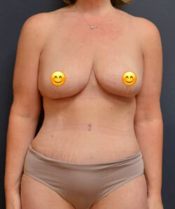 Mommy Makeover